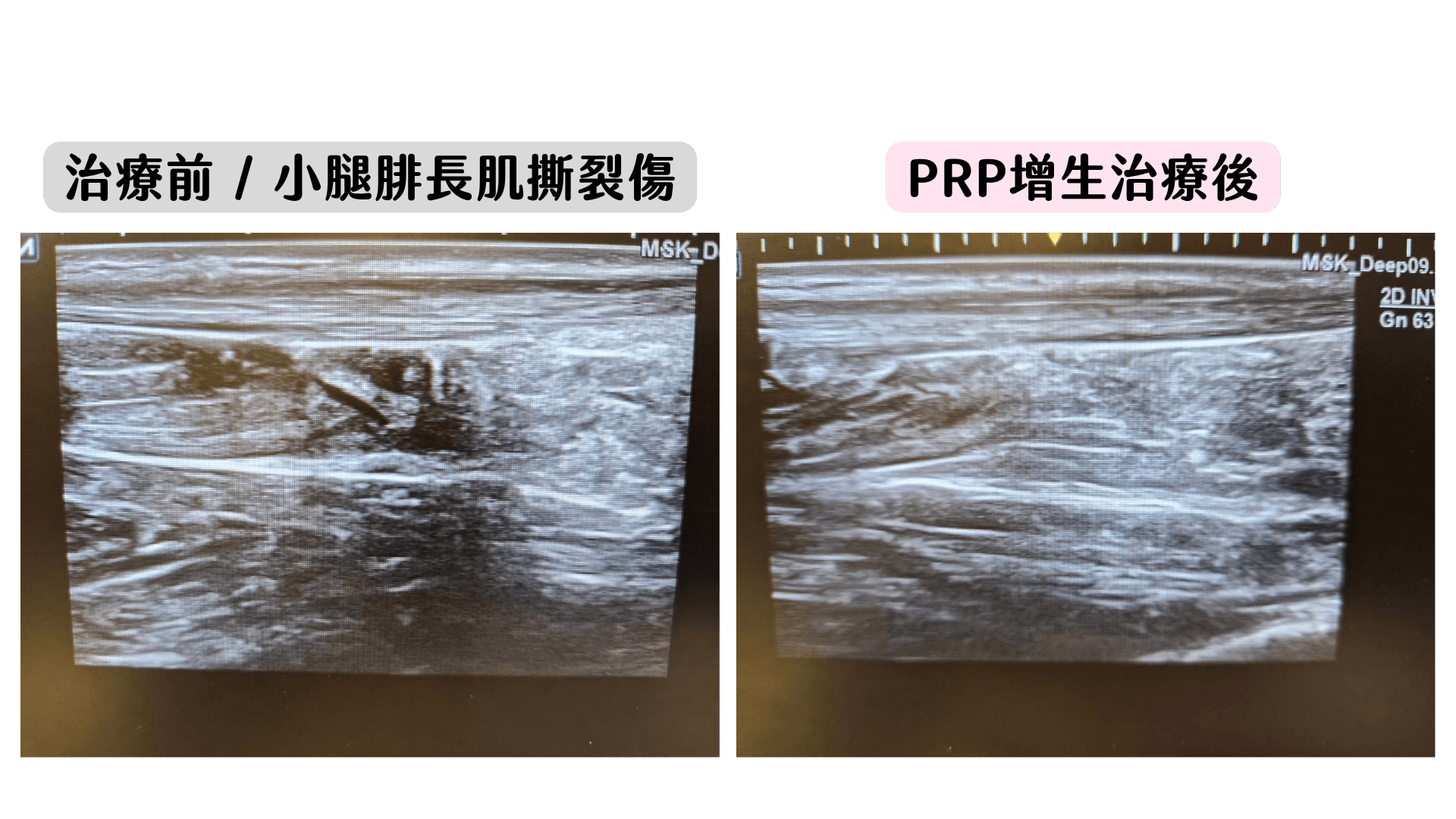 PRP增生療法
